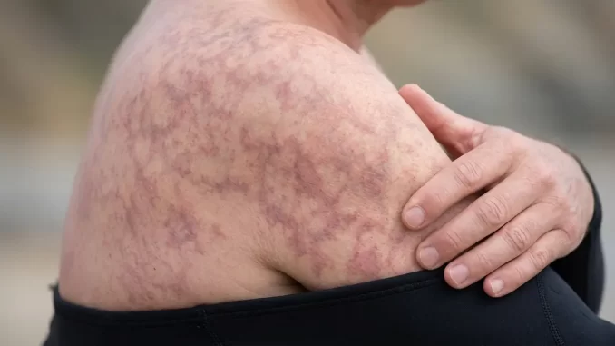 Netzartig marmorierte rötlich-bläuliche Hautverfärbung am Oberarm nach einem Tauchgang.